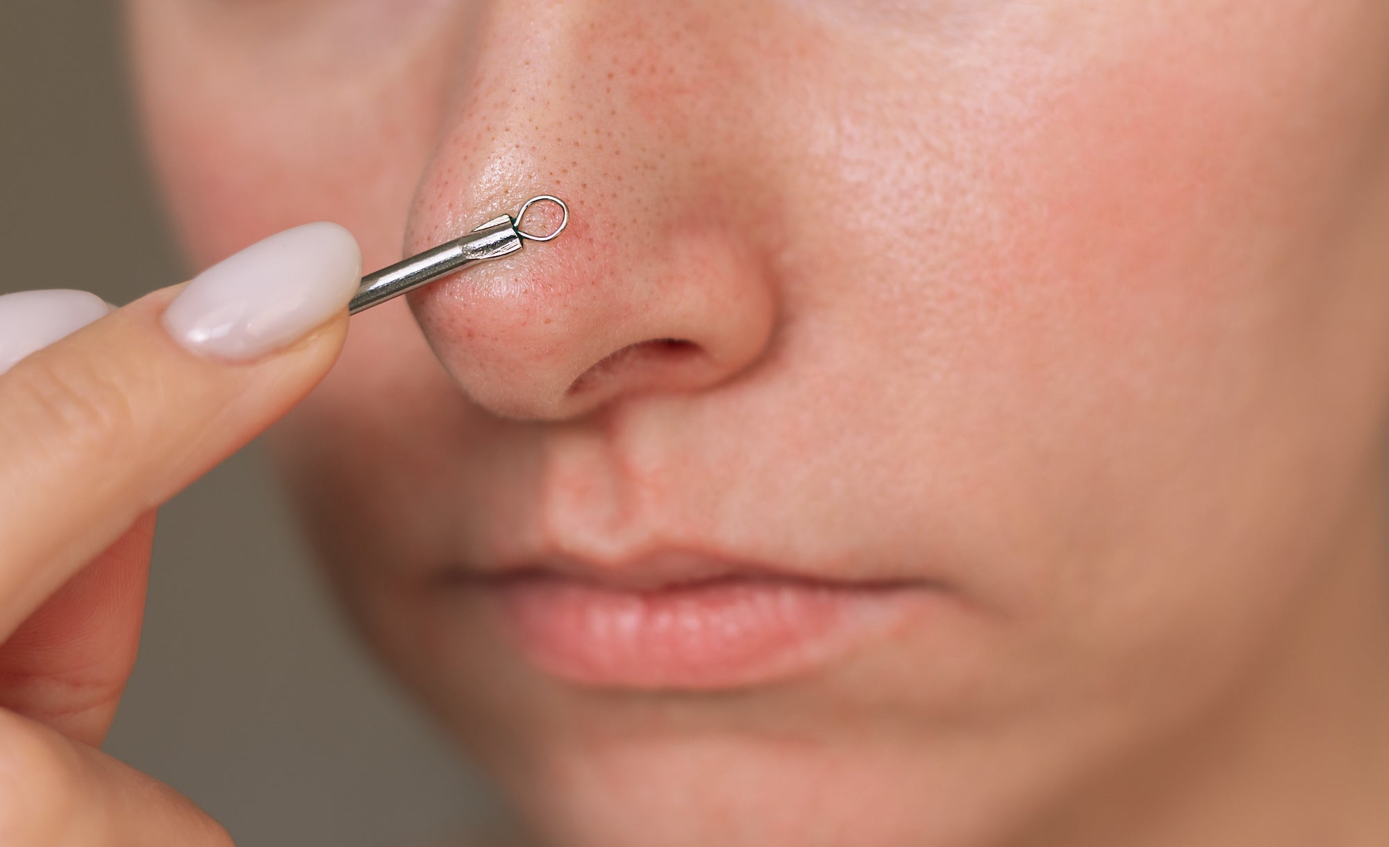 Understanding Blackheads and Whiteheads: What They Are and How to Treat Them