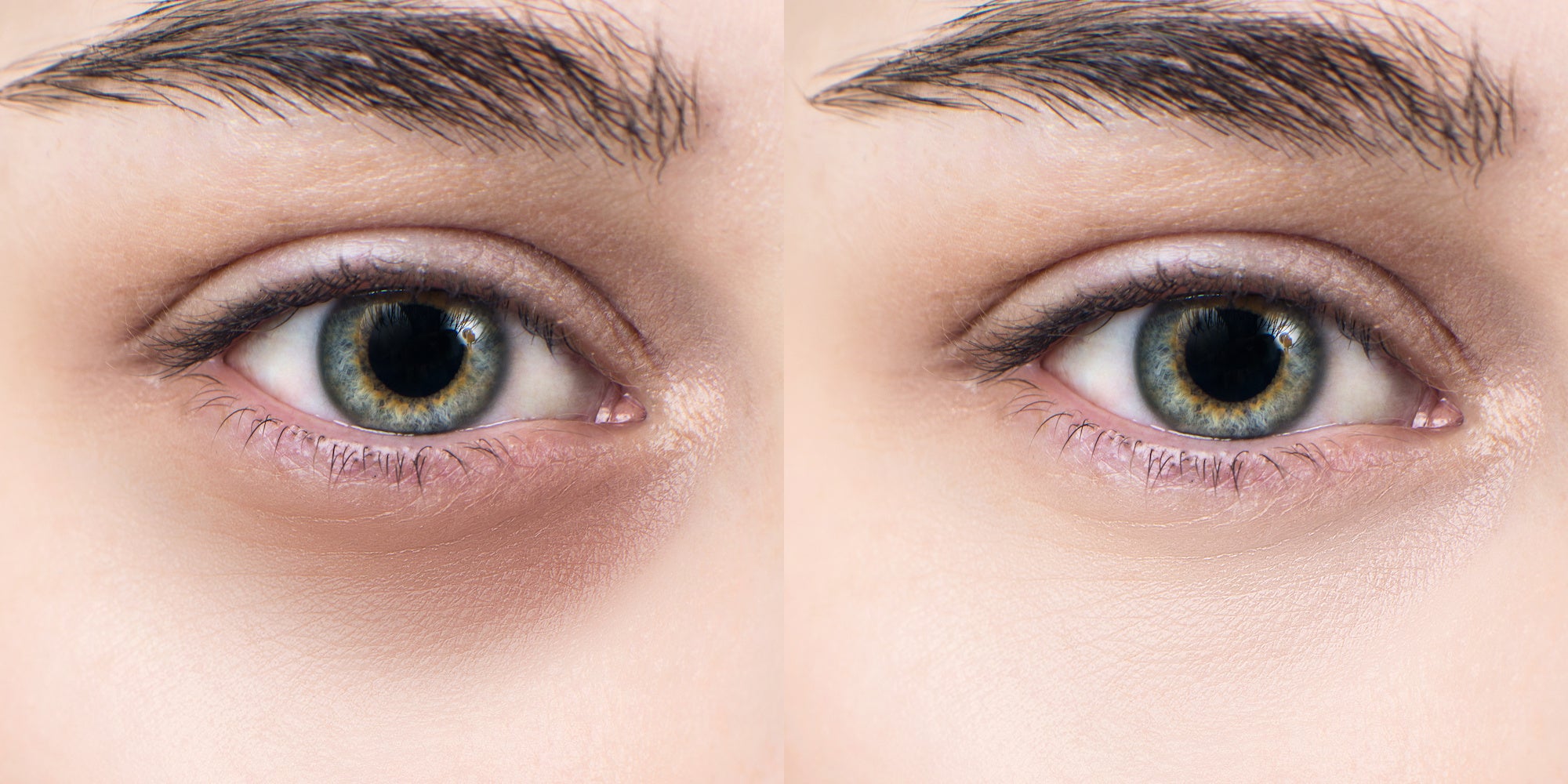 What causes dark circles around the eyes?