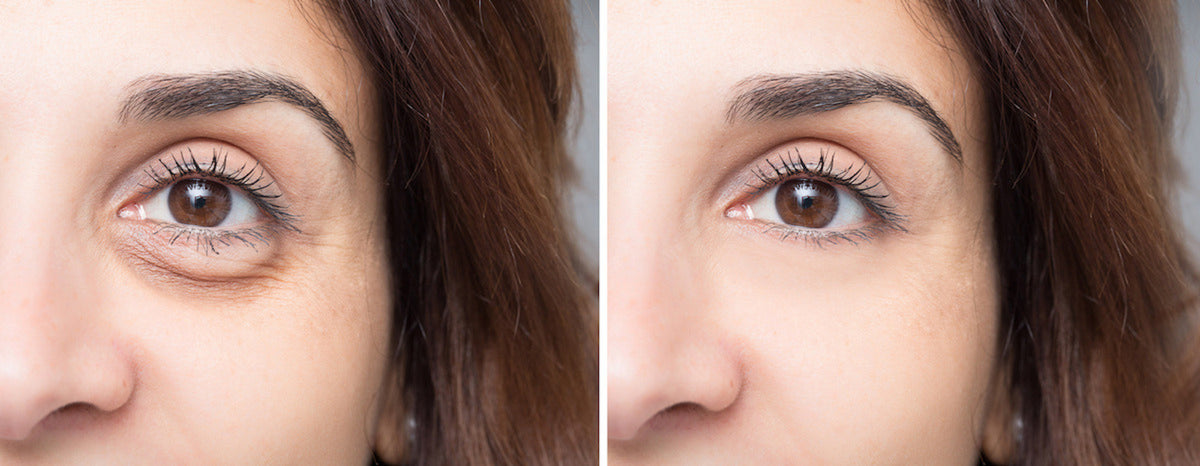 On Blepharoplasty with Oculoplastic Surgeon Dr. Maryam Zamani